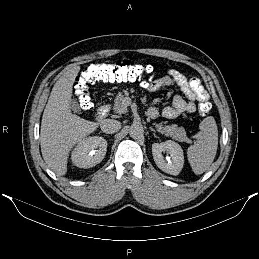 Acute appendicitis (Radiopaedia 84780-100240 Axial C+ delayed 34).jpg