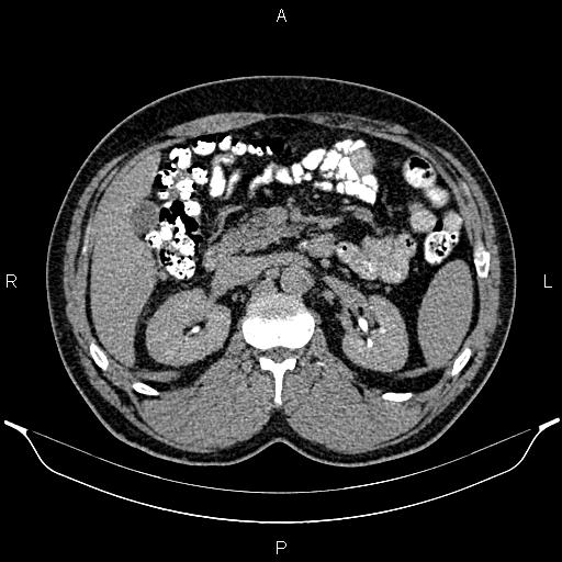File:Acute appendicitis (Radiopaedia 84780-100240 Axial C+ delayed 38).jpg