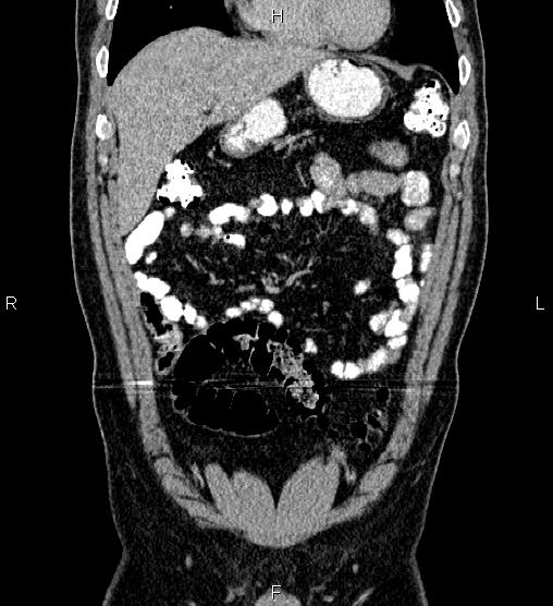Acute appendicitis (Radiopaedia 84780-100240 Coronal C+ portal venous phase 20).jpg