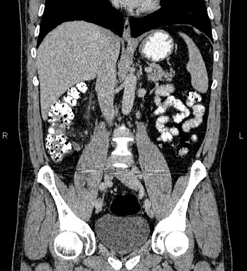 Acute appendicitis (Radiopaedia 84780-100240 Coronal C+ portal venous phase 43).jpg