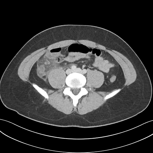 File:Acute appendicitis with appendicoliths (Radiopaedia 50186-55532 Axial C+ portal venous phase 51).png