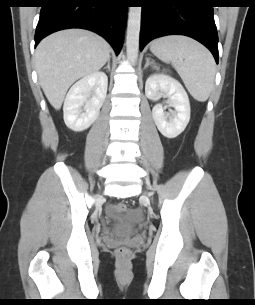 Acute appendicitis with appendicoliths (Radiopaedia 50186-55532 Coronal C+ portal venous phase 36).png