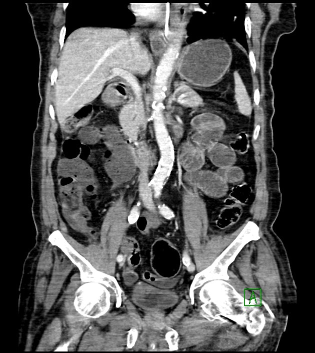 Acute arterial mesenteric ischemia (Radiopaedia 78238-90828 Coronal C+ portal venous phase 51).jpg
