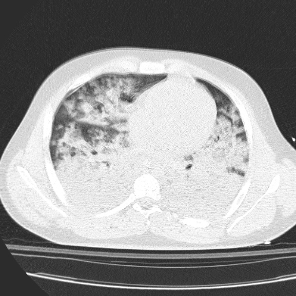 Acute aspiration pneumonitis (Radiopaedia 33605-34703 Axial lung window 57).jpg