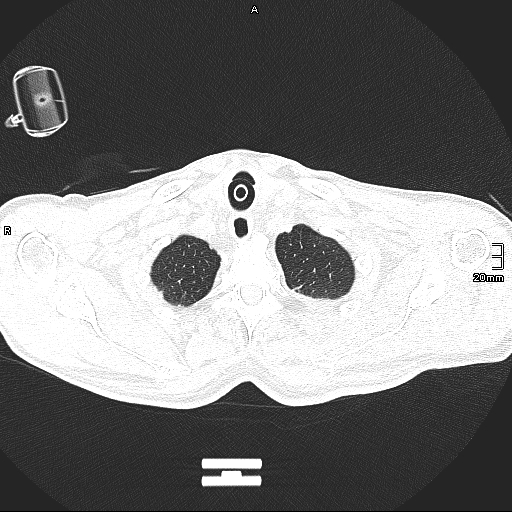 Acute aspiration pneumonitis (Radiopaedia 55642-62166 Axial lung window 23).jpg