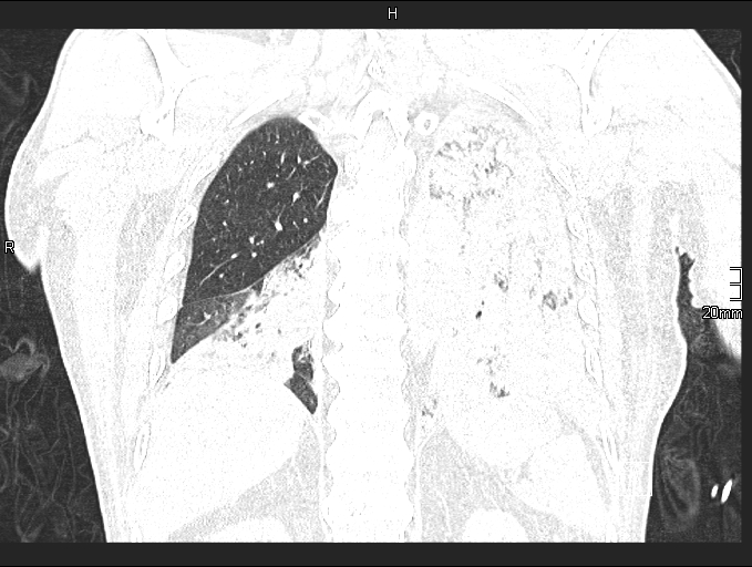 File:Acute aspiration pneumonitis (Radiopaedia 55642-62166 Coronal lung window 76).jpg