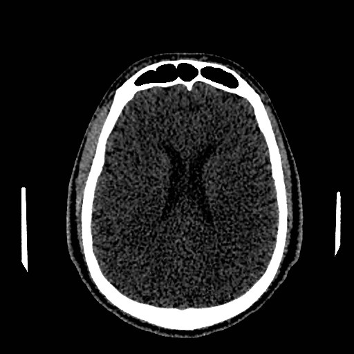Acute basilar artery occlusion (Radiopaedia 43582-46985 Axial non-contrast 112).jpg