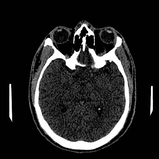 Acute basilar artery occlusion (Radiopaedia 43582-46985 Axial non-contrast 85).jpg