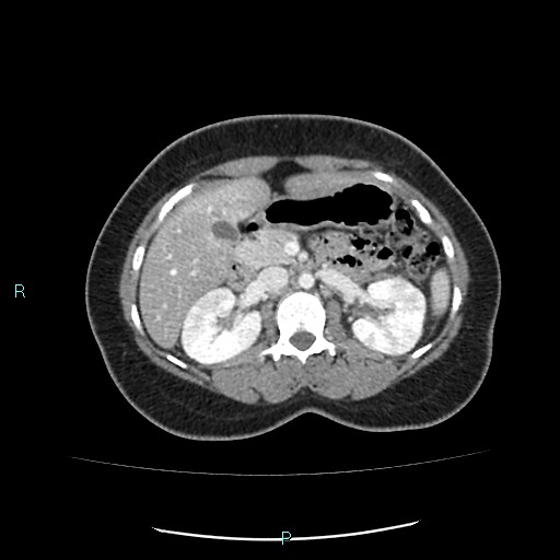 Acute bilateral pyelonephritis (Radiopaedia 37146-38881 Axial C+ portal venous phase 40).jpg
