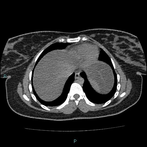 File:Acute bilateral pyelonephritis (Radiopaedia 37146-38881 Axial non-contrast 6).jpg