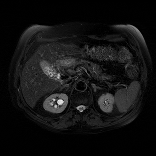 File:Acute cholecystitis complicated by pylephlebitis (Radiopaedia 65782-74915 Axial T2 fat sat 21).jpg