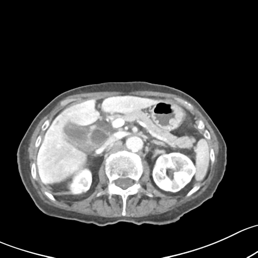 Acute cholecystitis with contained perforation (Radiopaedia 47328-51907 Axial C+ portal venous phase 25).png