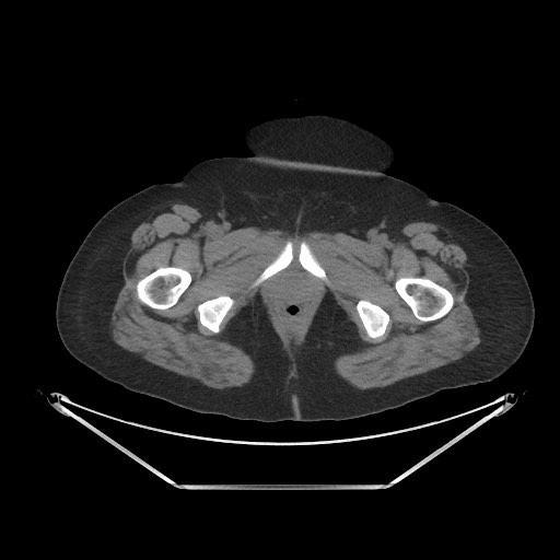 Acute cholecystitis with tensile fundus sign (Radiopaedia 71394-81723 Axial non-contrast 124).jpg