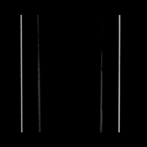 Acute cholecystitis with tensile fundus sign (Radiopaedia 71394-81723 Coronal non-contrast 135).jpg