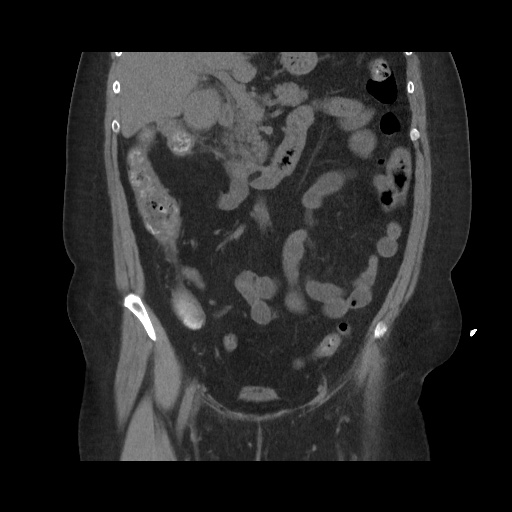 Acute cholecystitis with tensile fundus sign (Radiopaedia 71394-81723 Coronal non-contrast 60).jpg