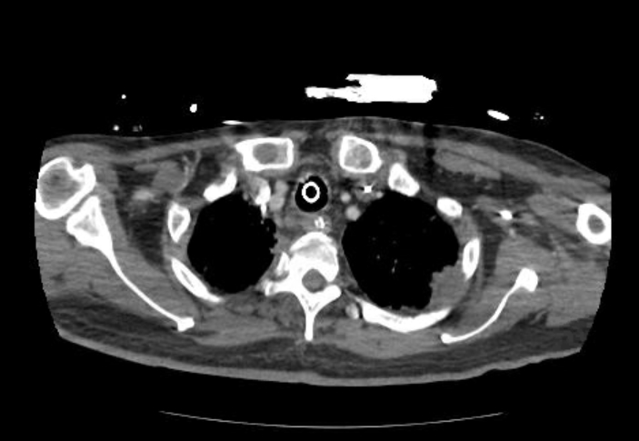 Acute cor pulmonale (ultrasound) (Radiopaedia 83508-98818 Axial C+ CTPA 4).jpg