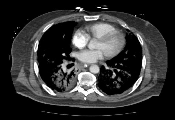 File:Acute cor pulmonale (ultrasound) (Radiopaedia 83508-98818 Axial C+ CTPA 46).jpg