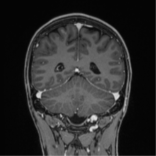 Acute disseminated encephalomyelitis (ADEM) (Radiopaedia 65319-74349 Coronal T1 C+ 6).png