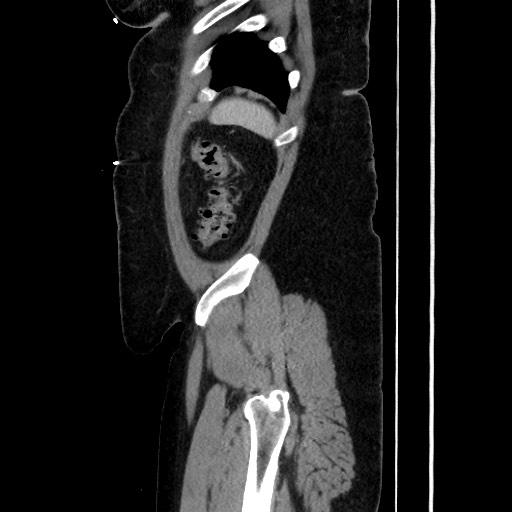 Acute diverticulitis - transverse colon (Radiopaedia 87063-103327 Sagittal C+ portal venous phase 186).jpg
