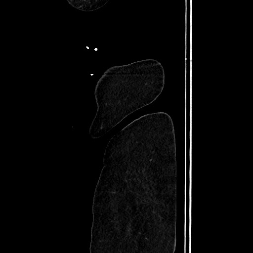 Acute diverticulitis - transverse colon (Radiopaedia 87063-103327 Sagittal C+ portal venous phase 220).jpg