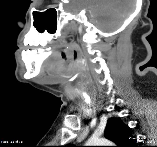 Acute epiglottitis (Radiopaedia 54375-60590 Sagittal C+ arterial phase 33).jpg