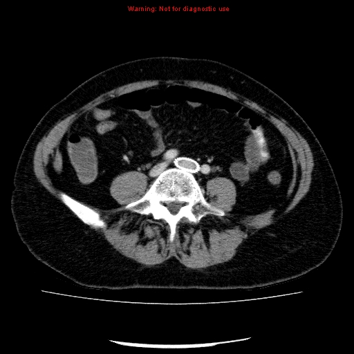 Acute gangrenous cholecystitis (Radiopaedia 10123-10661 Axial C+ portal venous phase 68).jpg