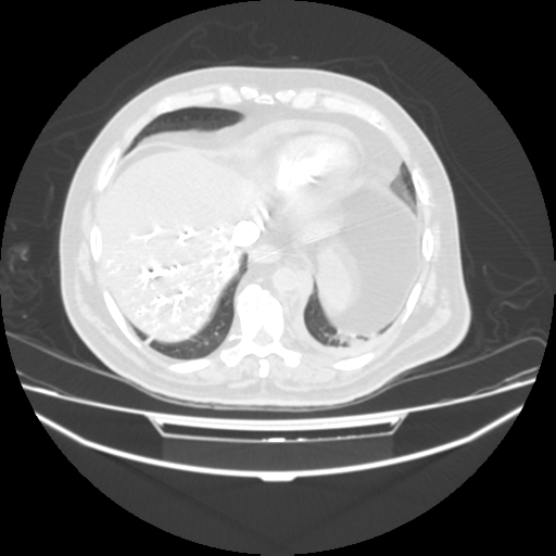 File:Acute heart failure (CT) (Radiopaedia 79835-93075 Axial lung window 41).png