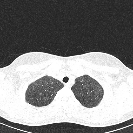 File:Acute hypersensitivity pneumonitis (Radiopaedia 85293-100870 Axial lung window 14).jpg