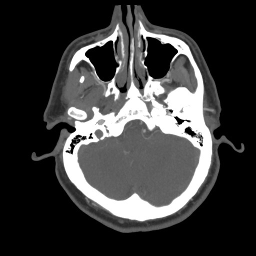 Acute internal carotid artery dissection (Radiopaedia 53541-59630 D 17).jpg