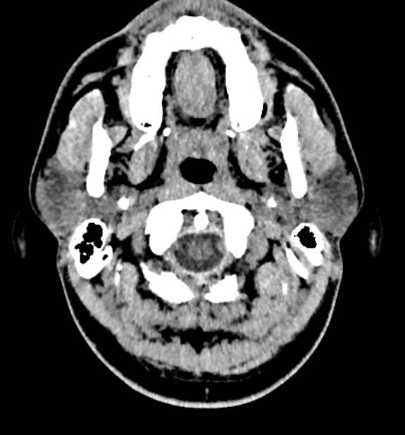 Acute ischemic stroke - posterior circulation territory (Radiopaedia 77670-89881 non-contrast 1).jpg
