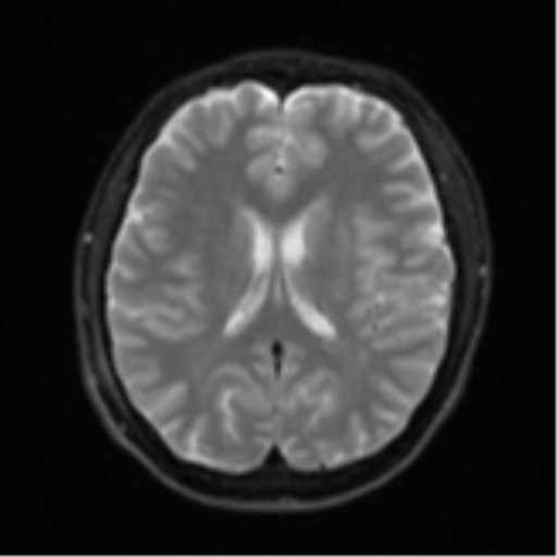 Acute left middle cerebral artery territory infarct with clot retrieval (Radiopaedia 47732-52433 Axial DWI 18).png