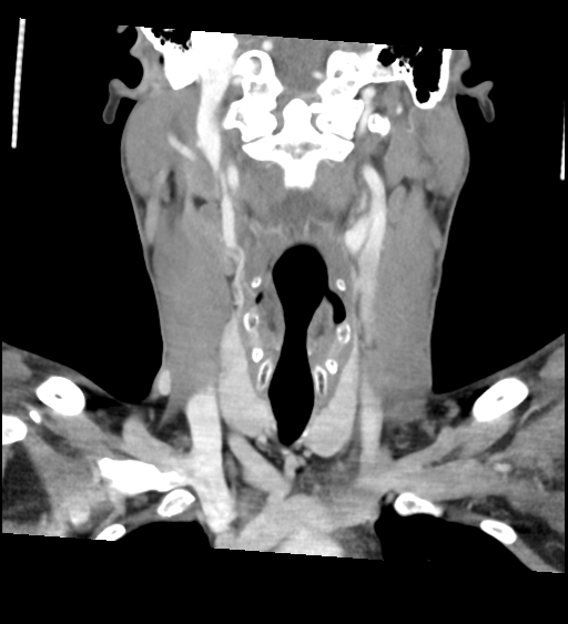 Acute longus colli calcific tendinitis (Radiopaedia 72495-83036 Coronal C+ arterial phase 31).jpg