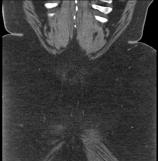Acute mesenteric venous ischemia (Radiopaedia 46041-50383 Coronal C+ portal venous phase 94).jpg