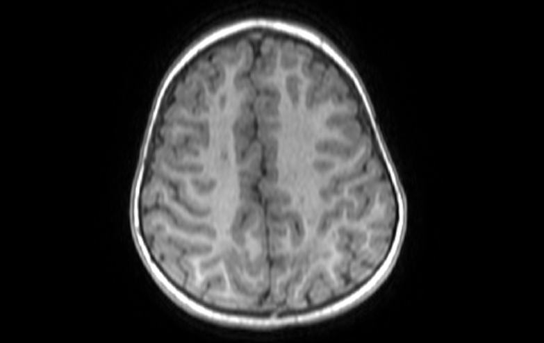 Acute necrotizing encephalitis of childhood (Radiopaedia 67356-76737 Axial T1 23).jpg