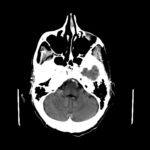 File:Acute necrotizing toxoplasma encephalitis (Radiopaedia 10683-11150 C+ arterial phase 25).jpg