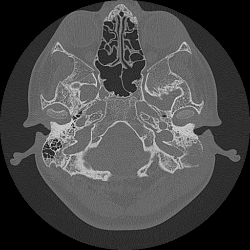 Acute otomastoiditis and Bezold abscess (Radiopaedia 88184-104786 Axial bone window 23).jpg