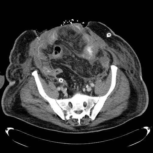 Acute pancreatic necrosis (Radiopaedia 13560-18503 Axial C+ portal venous phase 63).jpg