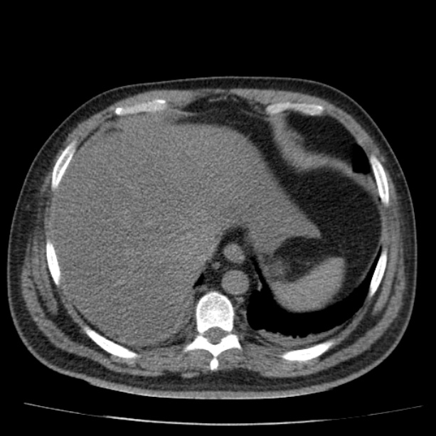 Acute pancreatitis (Radiopaedia 26663-26813 Axial non-contrast 18).jpg