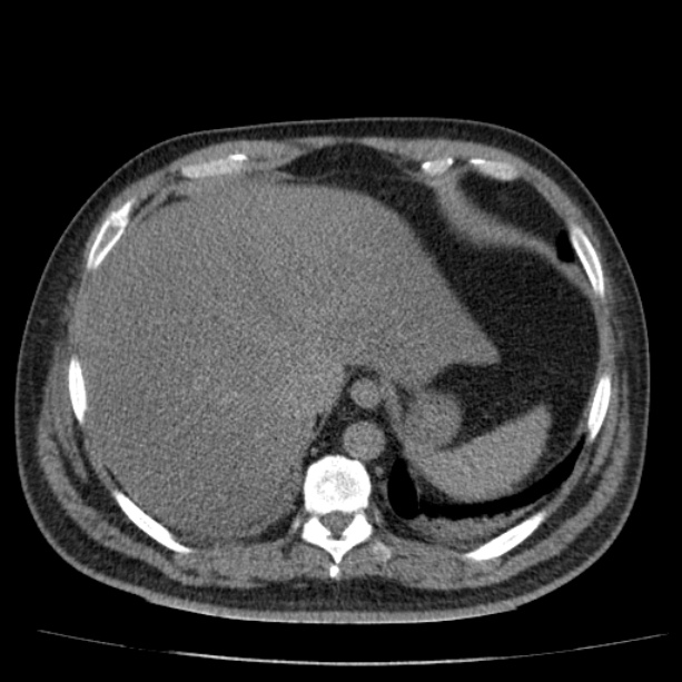 Acute pancreatitis (Radiopaedia 26663-26813 Axial non-contrast 19).jpg