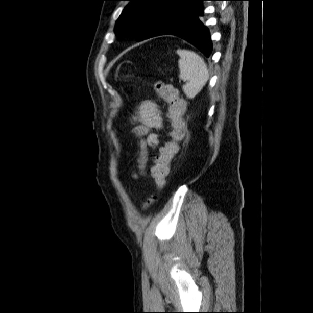Acute pancreatitis (Radiopaedia 26663-26813 Sagittal C+ portal venous phase 64).jpg