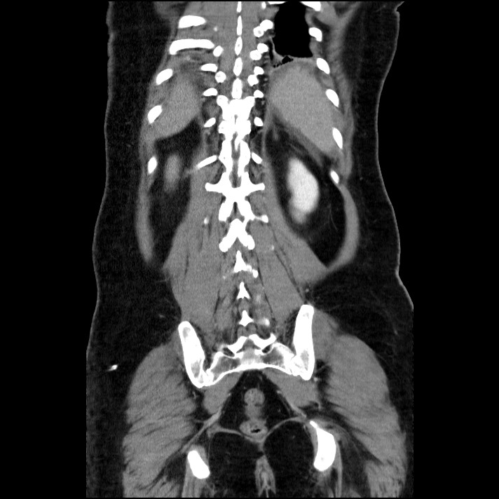 Acute pancreatitis (Radiopaedia 69236-79012 Coronal C+ portal venous phase 23).jpg
