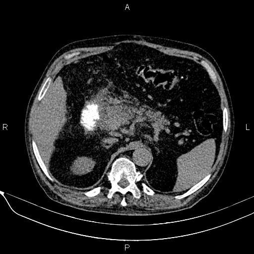 File:Acute pancreatitis (Radiopaedia 85146-100701 Axial non-contrast 39).jpg