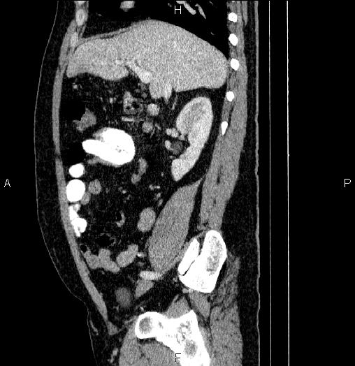 Acute pancreatitis (Radiopaedia 85390-101010 Sagittal C+ portal venous phase 34).jpg