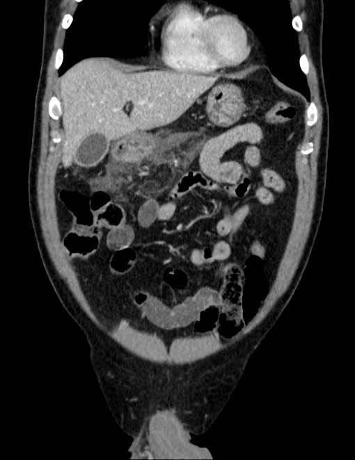 Acute pancreatitis - Balthazar E (Radiopaedia 23080-23110 Coronal C+ portal venous phase 18).jpg