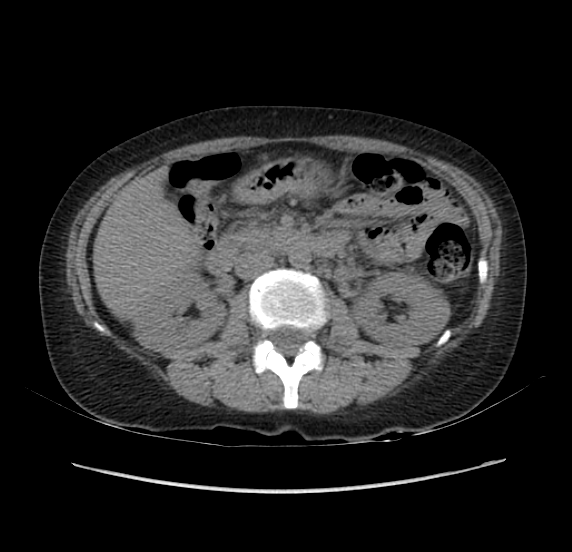 File:Acute pancreatitis - Balthazar E - post ERCP (Radiopaedia 27562-27772 Axial non-contrast 25).png
