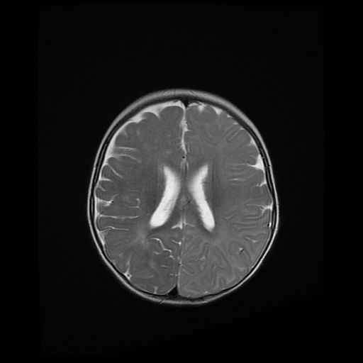 File:Acute phase of hemiconvulsion-hemiplegia epilepsy syndrome (Radiopaedia 29309-29745 Axial T2 9).jpg