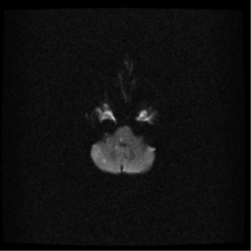 File:Acute pontine infarct from vertebral artery dissection (Radiopaedia 34111-35370 Axial DWI 5).png