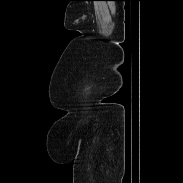 Acute pyelonephritis (Radiopaedia 25657-25837 Sagittal renal parenchymal phase 10).jpg