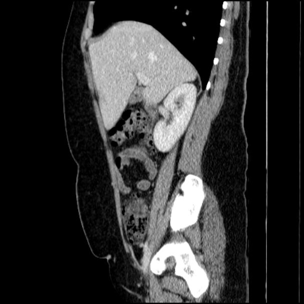 Acute pyelonephritis (Radiopaedia 33397-34434 Sagittal renal parenchymal phase 32).jpg