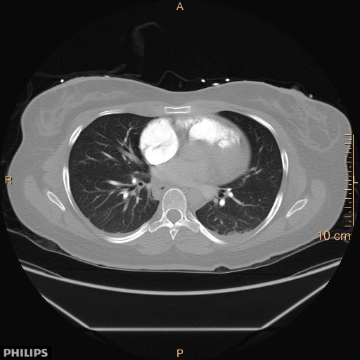File:Acute reversible pulmonary hypertension and right heart failure from cocaine toxicity (Radiopaedia 49394-54517 Axial C+ CTPA 6).jpg